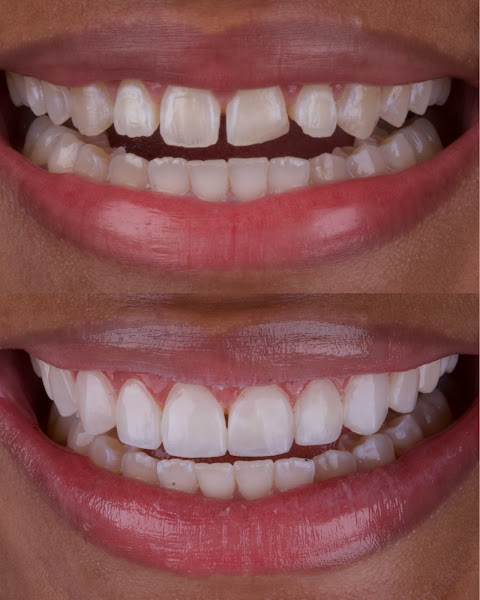 Foto 2 de Dra. Isabella Muccillo | Facetas de resina e harmonização facial