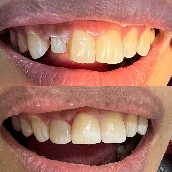Foto 2 de Dra Jaciara Santana- ODONTOLOGIA DO SONO- Clareamento Dental- Restauração Em Resina- Profilaxia (Limpeza)- Raspagem