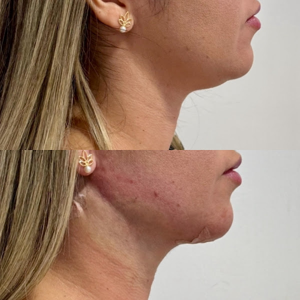 Foto 2 de Dra Janayna Oliveira | Harmonização Facial e Platismoplastia