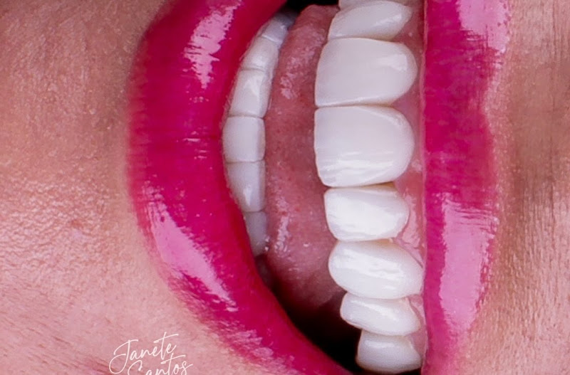 Foto 3 de Dra. Janete Santos - Guarulhos/ lentes em resina / Harmonização em Guarulhos/Clinica JS