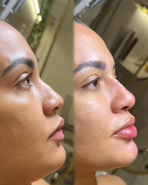 Foto 2 de Dra Jéssica Sena - Estética e Harmonização (face e corpo)