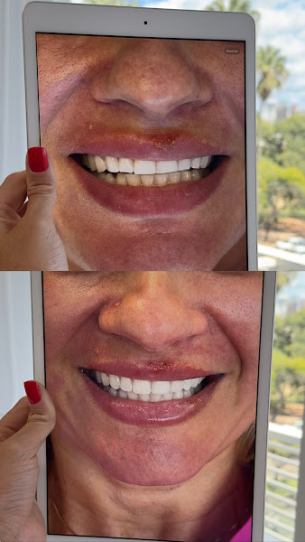 Foto 3 de Dra Jéssica Soares | Consulta | Bruxismo | Facetas | Clareamento| Restauração| Revisão |Periodontia DENTISTA PORTO ALEGRE