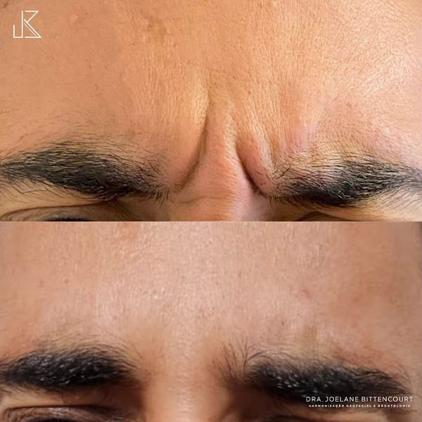 Foto 3 de Dra. Joelane Bittencourt | Harmonização Orofacial