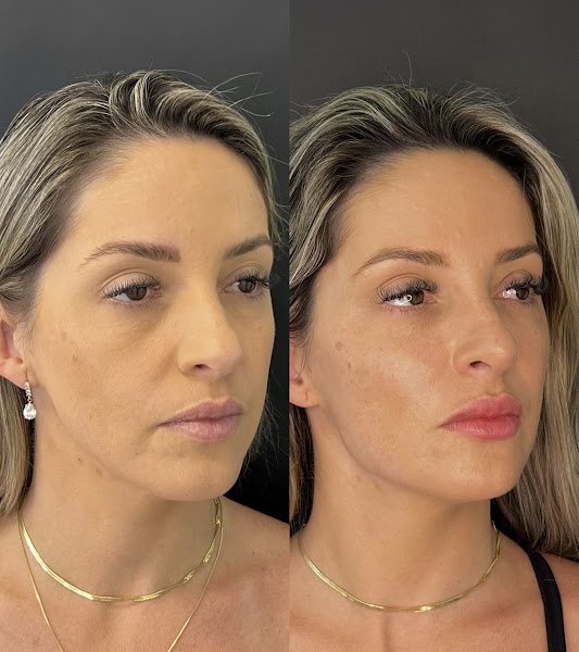 Foto 2 de Dra. Júlia Meireles - Harmonização facial em Santa Cruz do Sul