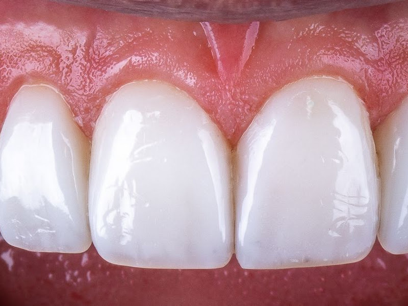 Foto 3 de Dra Juliana Lima - Atendimento Particular - Prevenção - Raspagens Dentárias - Clareamento Dental