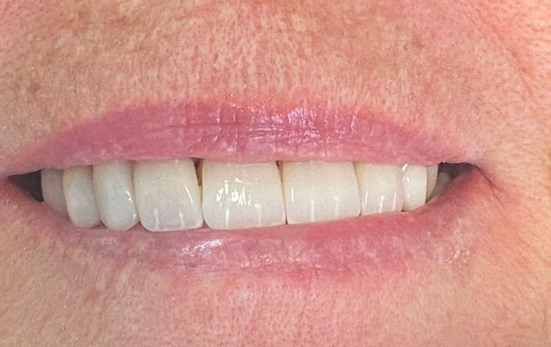 Foto 3 de Dra.Juliana Lody Dental Studio |DENTISTA EM SANTOS|LENTE DE CONTATO|ALINHADOR INVISÍVEL|HARMONIZAÇÃO OROFACIAL|REABILITAÇÃO|