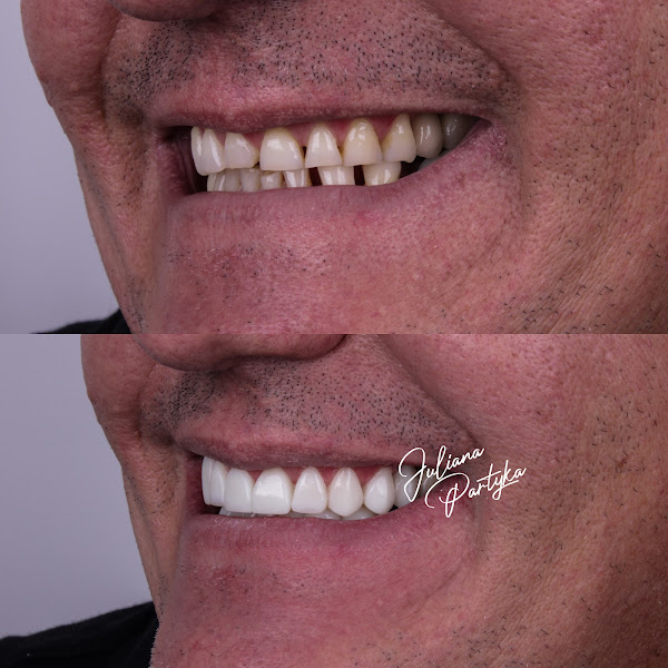 Foto 2 de Dra Juliana Partyka -Lentes em resina em Apucarana