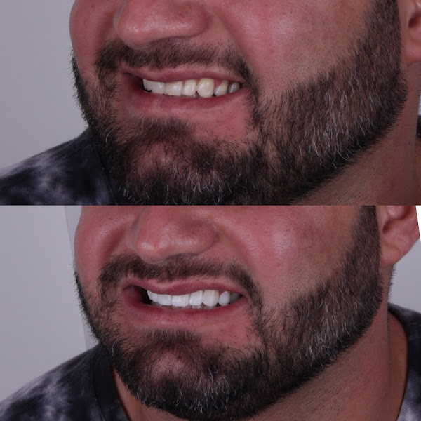 Foto 3 de Dra Juliana Partyka -Lentes em resina em Apucarana