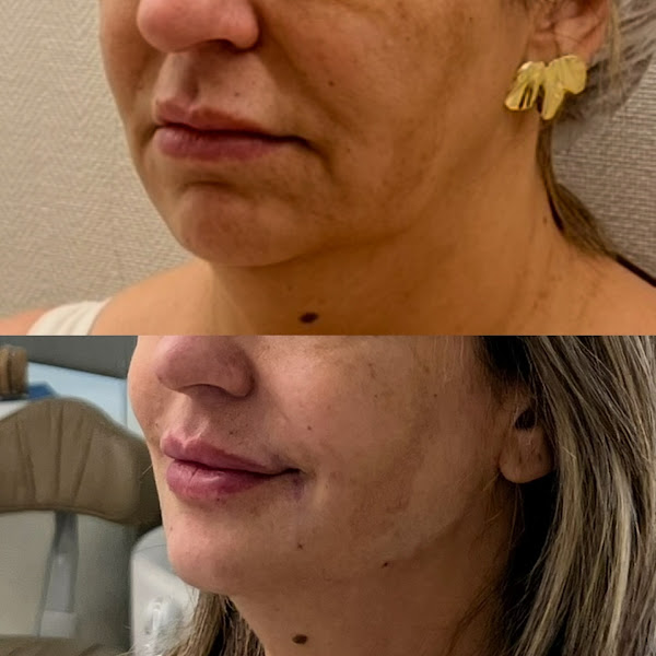 Foto 3 de Dra. Juliana Quintana | Harmonização Facial e Botox em Rio Grande