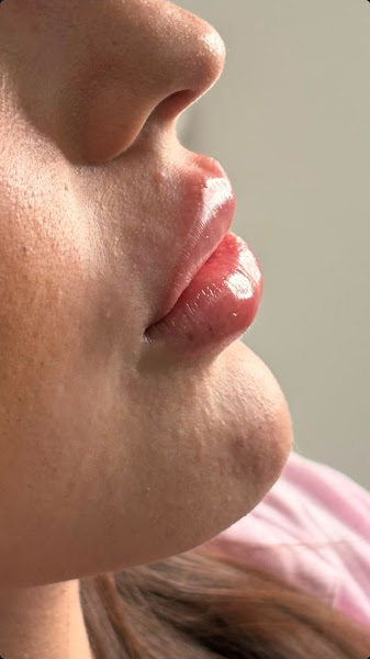 Foto 3 de Dra. Juliana Saraiva - Preenchimento Labial e Harmonização Orofacial em Cabo Frio