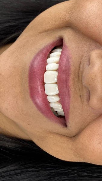 Foto 2 de Dra. Karina Mary - Facetas / Lentes em Resina Composta em Cacoal - Rondônia