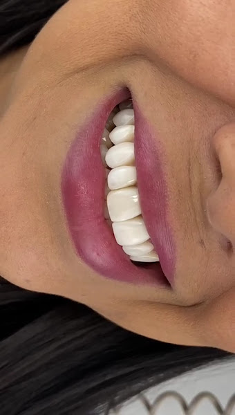 Foto 3 de Dra. Karina Mary - Facetas / Lentes em Resina Composta em Cacoal - Rondônia