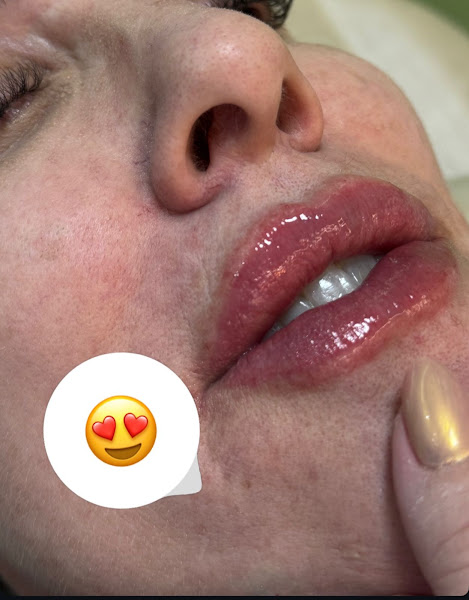 Foto 3 de Dra Karine Dalosse | Harmonização Orofacial | Dentista