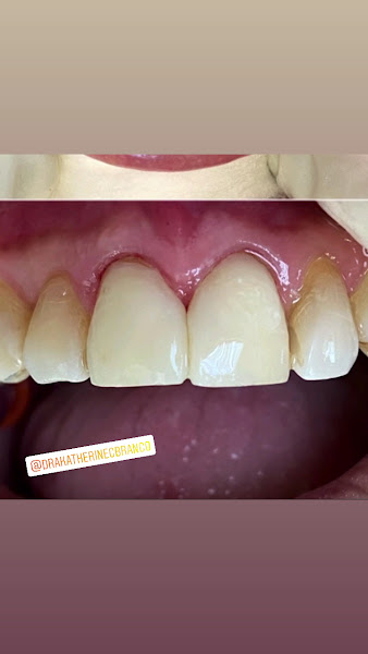 Foto 3 de Dra Katherine C Branco - Dentista | Implante Dentário