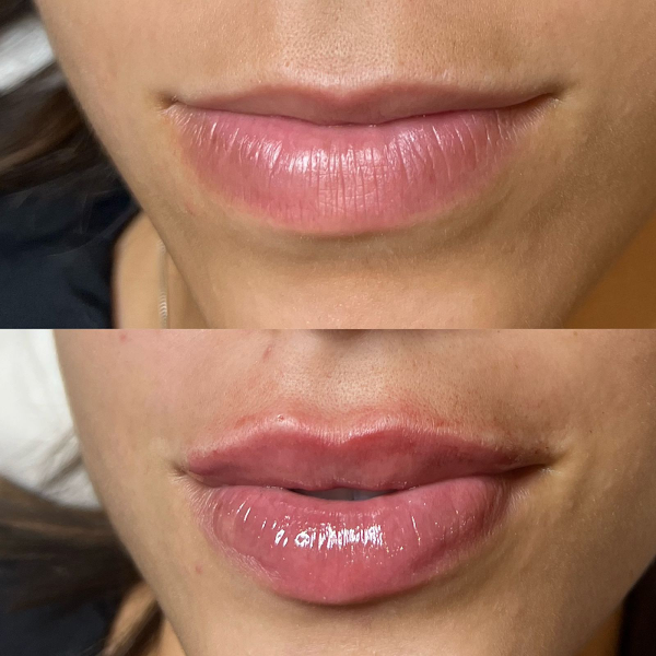 Foto 3 de Dra. Keizy Wandermurem | Cirurgiã Dentista - Harmonização Orofacial