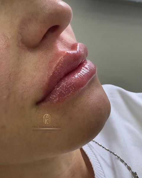 Foto 3 de Dra. Ketheleen Maciel | Harmonização Facial em Santos