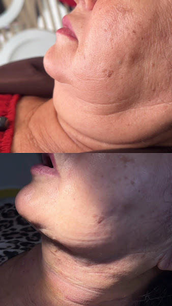 Foto 3 de Dra. Kimie Takahachi Lipo de papada e Harmonização facial