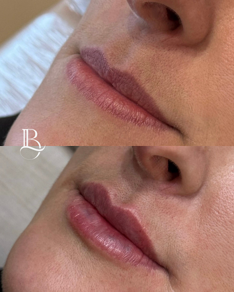 Foto 3 de Dra. Laiane Breunig - Harmonização Facial