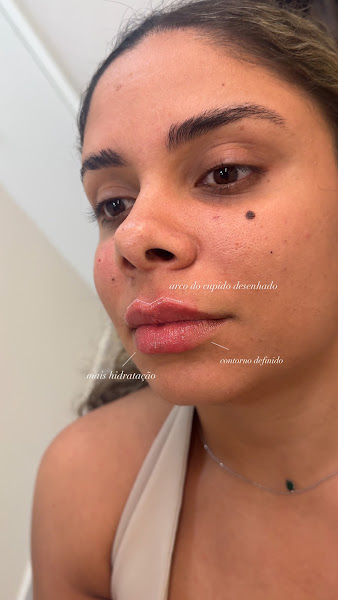 Foto 3 de Dra Laila Santos - Referência em Harmonização Facial em Santos