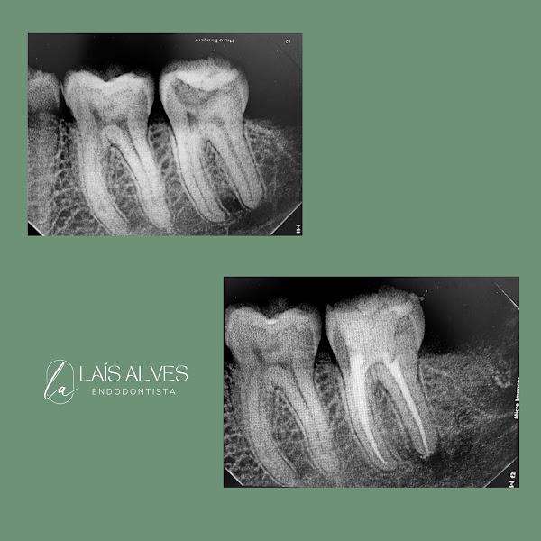 Foto 3 de Dra Laís Alves Endodontia e Clinico Geral Dentista Mogi das Cruzes|
