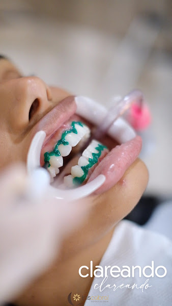 Foto 4 de Dra. Lais Cabral | Clareamento e Lentes de Contato Dental em Maceió