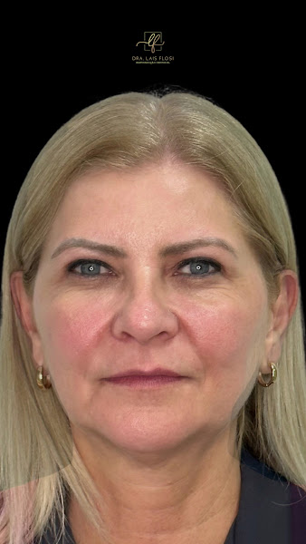 Foto 3 de Dra. Lais Flosi - Harmonização Orofacial