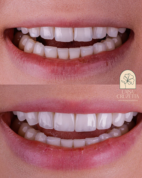 Foto 3 de Dra. Laisa Cruzetta- Lentes De Contato em Resina Composta e Porcelana e Implantes Dentários