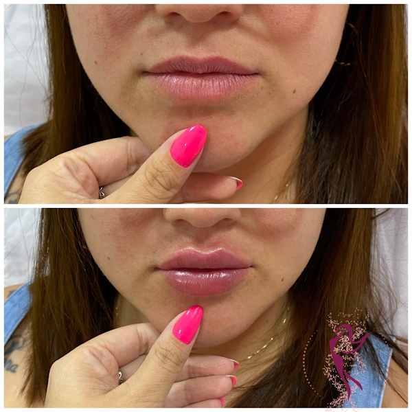 Foto 3 de Dra. Lana Bastazini | Harmonização Facial
