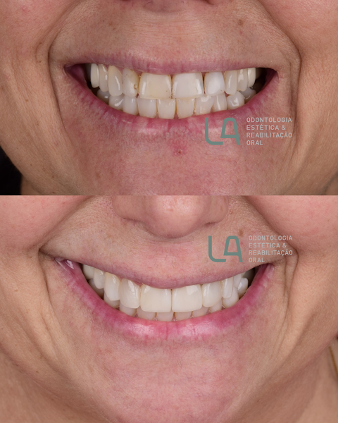 Foto 3 de Dra. Larissa Araújo | Dentista Bela Vista | Facetas em resina | Facetas em porcelana