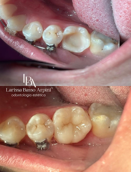 Foto 2 de Dra. Larissa Basso Arpini - Dentista Lentes em Resina em Porto Alegre