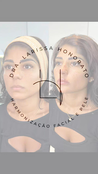 Foto 3 de Dra Larissa Honorato Harmonização Facial e Pele