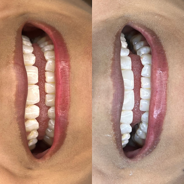 Foto 2 de Dra. Larissa Ketelen | Odontologia estética personalizada