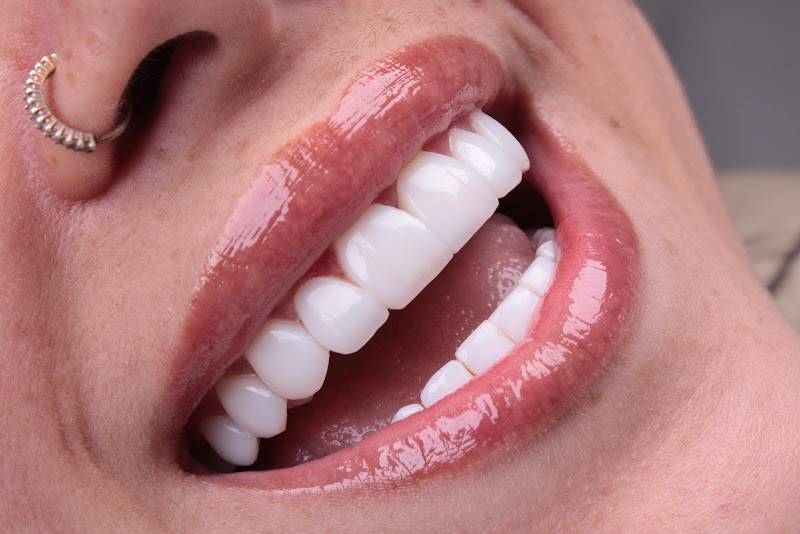 Foto 3 de Dra. Larissa Matheus - Lentes em resina