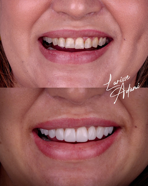 Foto 3 de Dra Larisse Adaami Odontollogia Estètiica - Lentes de contato dental, facetas de resina, clareamento, limpeza.