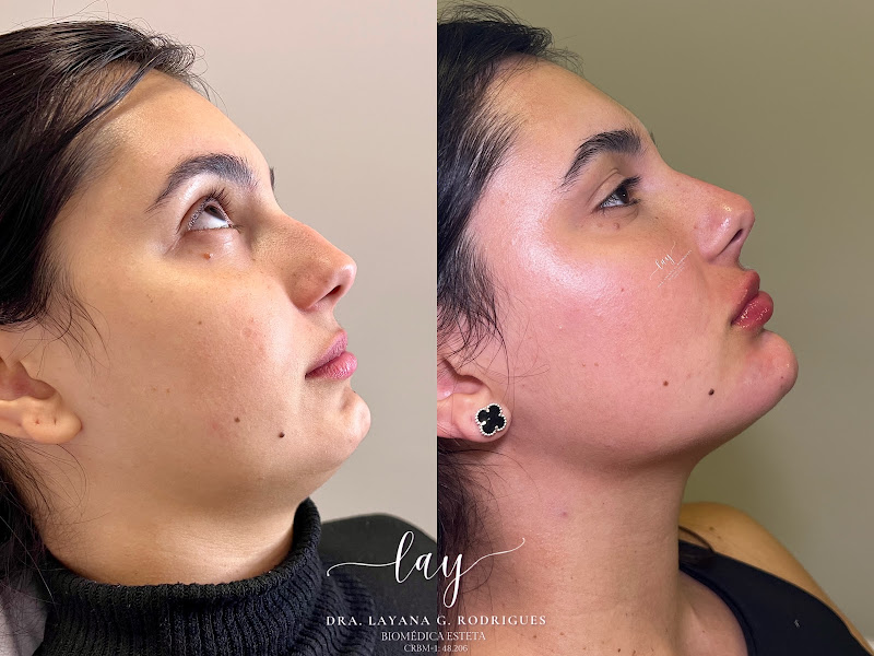 Foto 3 de Dra. Layana G. Rodrigues - Harmonização Facial e Corporal