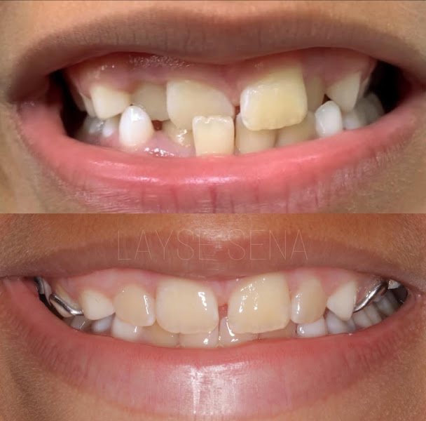 Foto 3 de Dra. Layse Sena - Dentista