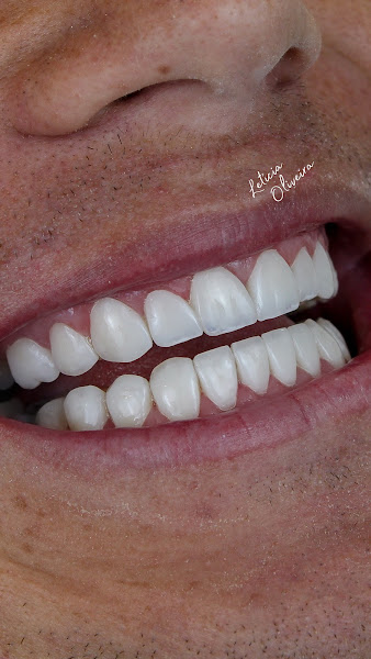 Foto 2 de Dra. Letícia Oliveira - Lentes em resina