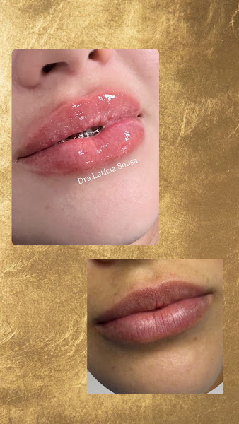 Foto 2 de Dra. Letícia Sousa - Estética Avançada | Preenchimento, Botox, Fios de PDO, bioestimulador.