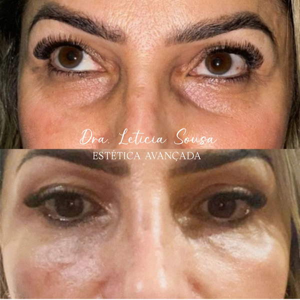 Foto 3 de Dra. Letícia Sousa - Estética Avançada | Preenchimento, Botox, Fios de PDO, bioestimulador.