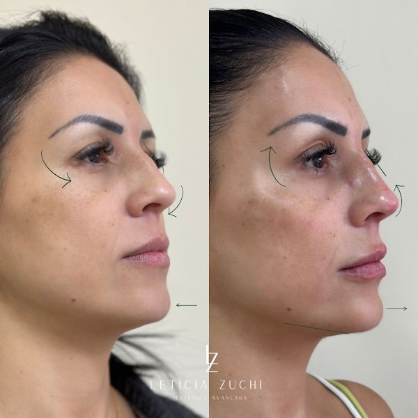 Foto 3 de Dra Letícia Zuchi / Harmonização Facial em Barueri