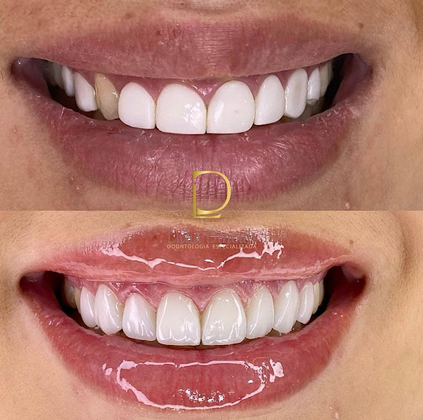 Foto 3 de Dra Lídia Dinoah - Dentista - Facetas e Harmonização