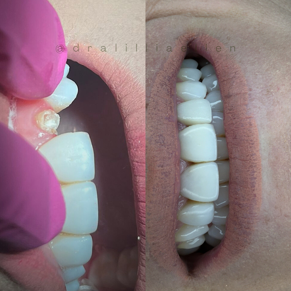 Foto 2 de Dra. Lillia Ellen - Odontologia Estética e Reabilitadora.