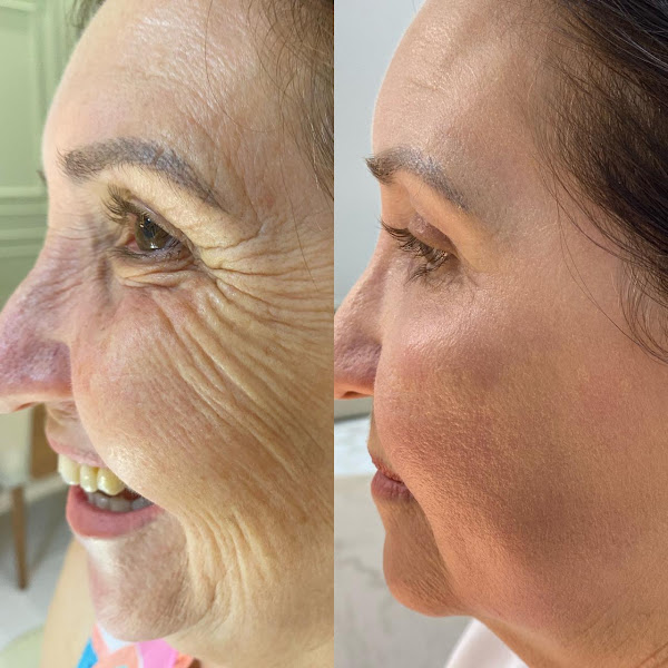 Foto 3 de Dra Liziane Herberts - Harmonização Facial - Sinop MT