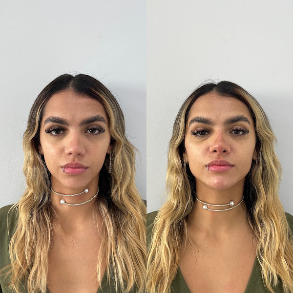 Foto 2 de Dra. Lorena Fontenele | Preenchimento labial | Botox I Rinomodelação I Harmonização Facial e Corporal em Duque de Caxias