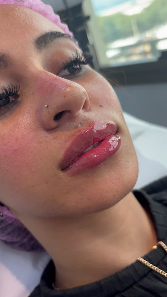 Foto 3 de Dra. Lorena Fontenele | Preenchimento labial | Botox I Rinomodelação I Harmonização Facial e Corporal em Duque de Caxias