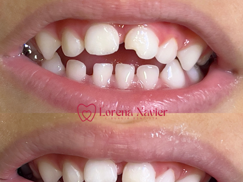 Dra. Lorena Xavier - Odontopediatria - Castelo BH