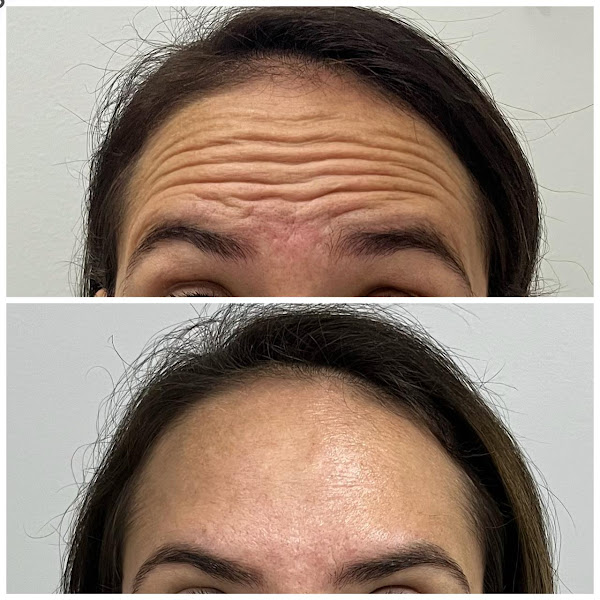 Foto 3 de Dra Lorrane Cardoso - Harmonização Facial Anápolis