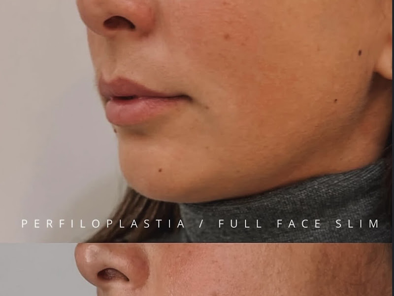 Foto de Dra. Luane Ávila -Preenchimento labial, rinomodelação, Perfiloplastia, full face, harmonização, cicatriz de acne, olheiras