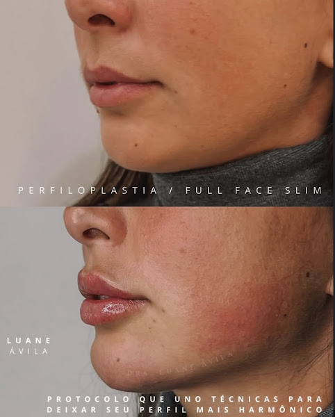Foto 2 de Dra. Luane Ávila -Preenchimento labial, rinomodelação, Perfiloplastia, full face, harmonização, cicatriz de acne, olheiras