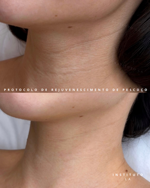 Foto 3 de Dra. Luane Ávila -Preenchimento labial, rinomodelação, Perfiloplastia, full face, harmonização, cicatriz de acne, olheiras